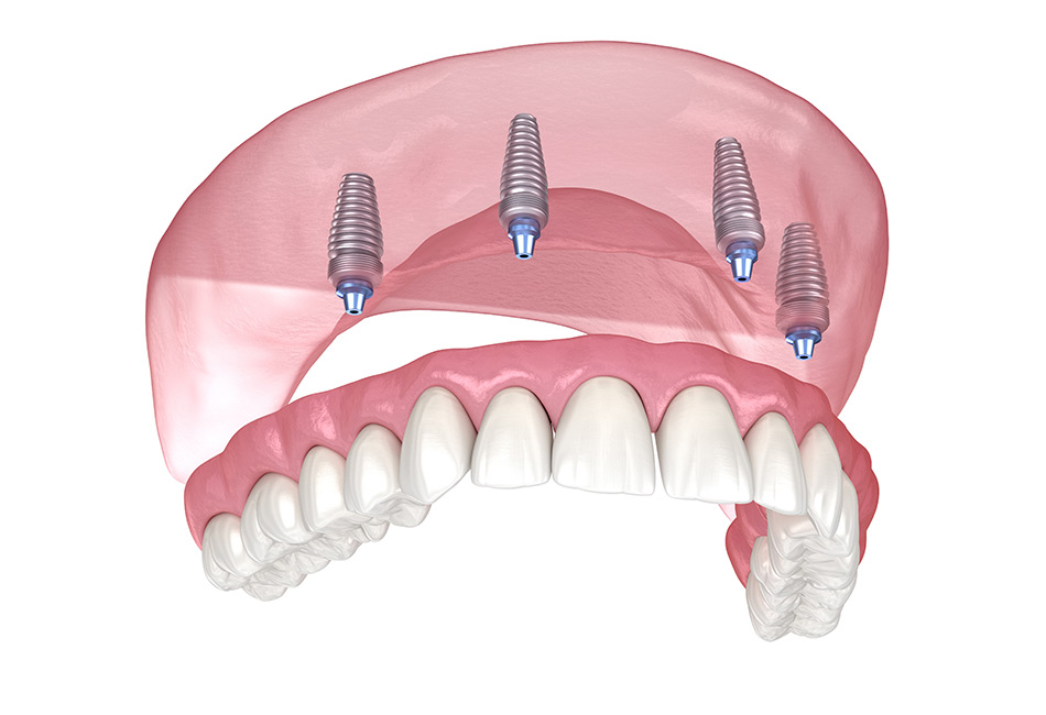 Full Arch Dental Implants